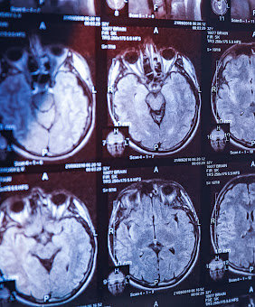 Multiple MRI scans of someone's head after a traumatic brain injury in Louisiana.