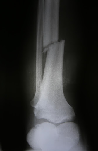 Bones, like this one seen in x-ray, can break in many different ways.