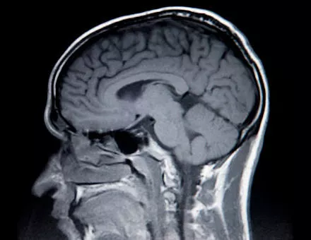 A side cross section of someone's brain after an accident