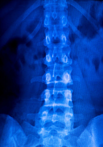 An x-ray of someone's spinal cord