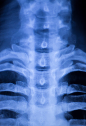 An x-ray of a catastrophic spinal cord injury