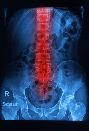 Quadriplegic injuries are often the result of trauma to the spinal cord.