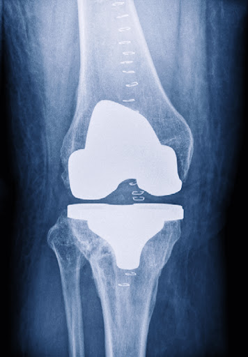 An X-ray of a knee after replacement surgery. A defective joint implant can cause a host of complications.