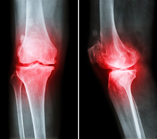 An X-ray of a knee joint from the front and the side, with red shading to indicate pain.