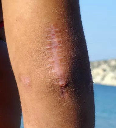 A large scar on the back of an injury victim's arm