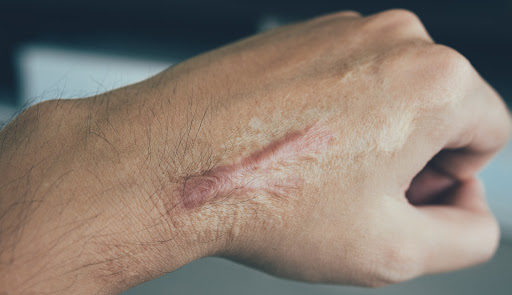 A keloid scar on the back of someone's hand