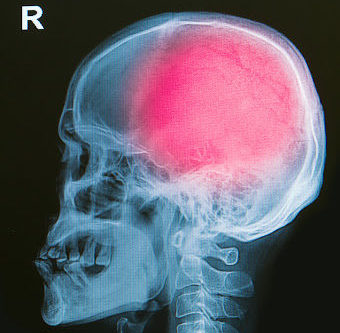 An x-ray of someone's head, showing brain injuries from an accident