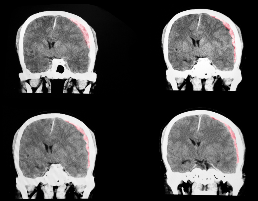 brain scan of traumatic brain injury from helicopter crash