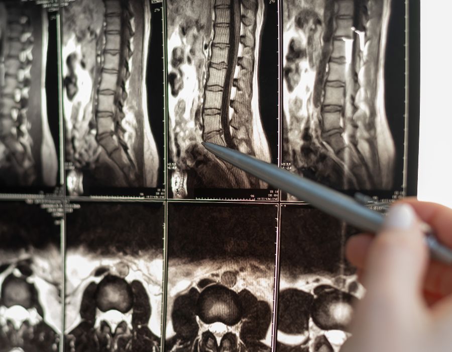 spinal cord injury xrays from doctor