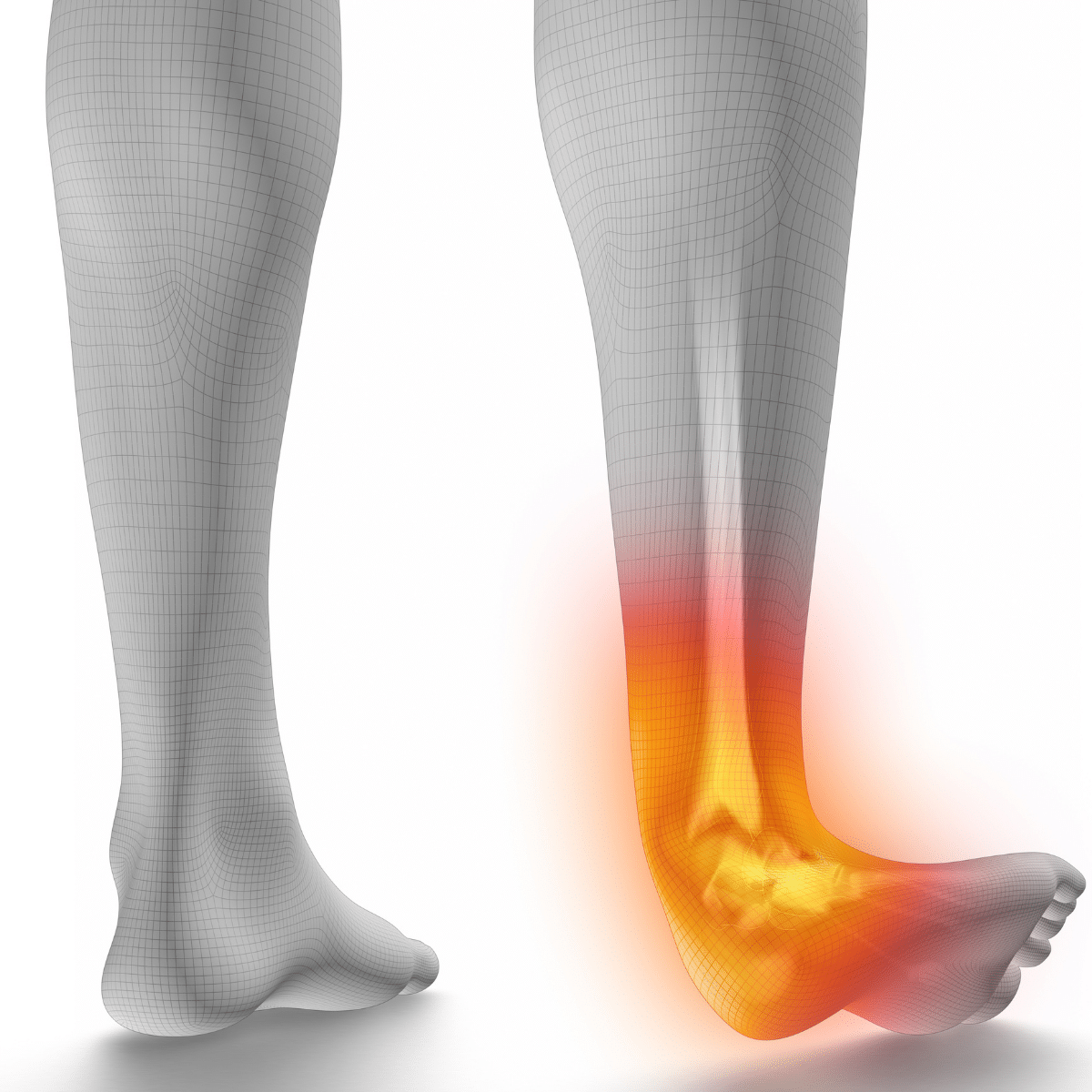 Louisiana Sprain Injury Lawyer - Get Gordon McKernan