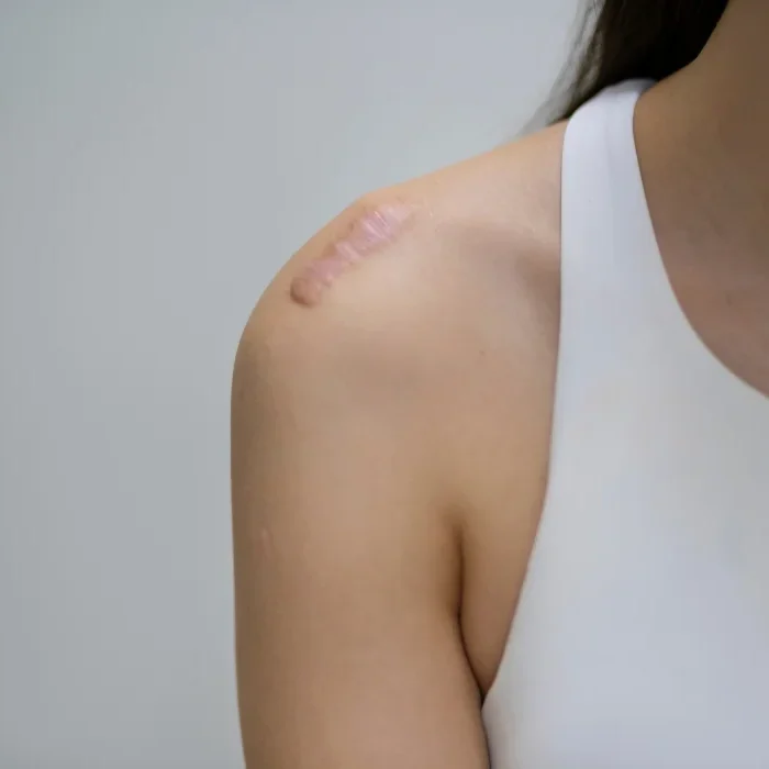 Scarring and Disfigurement Lawyer