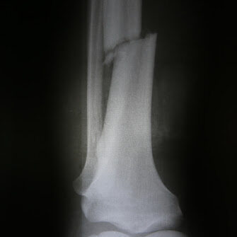 X-ray photos of bone fracture patients