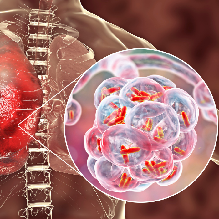 Dearborn Legionnaires' Disease Outbreak