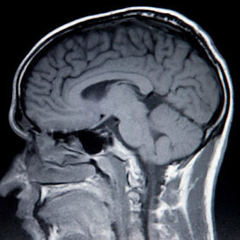 MRI brain scan