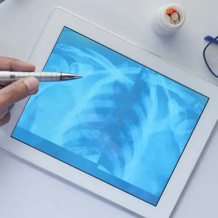 Monroe personal injury attorney x-ray of ribs