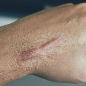 Scar on human skin keloid on hand.