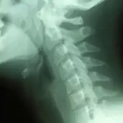 x-ray-of-neck radiografía de cuello
