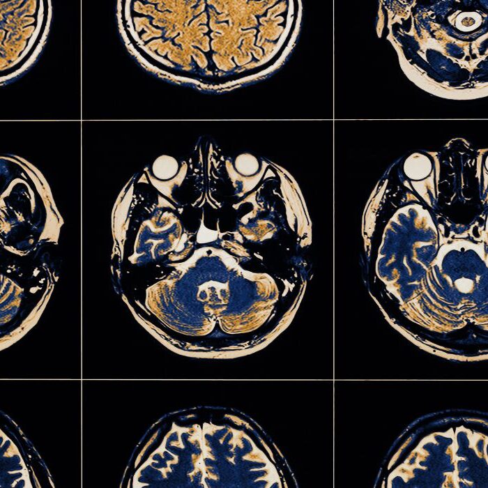 yellow and blue brain scan